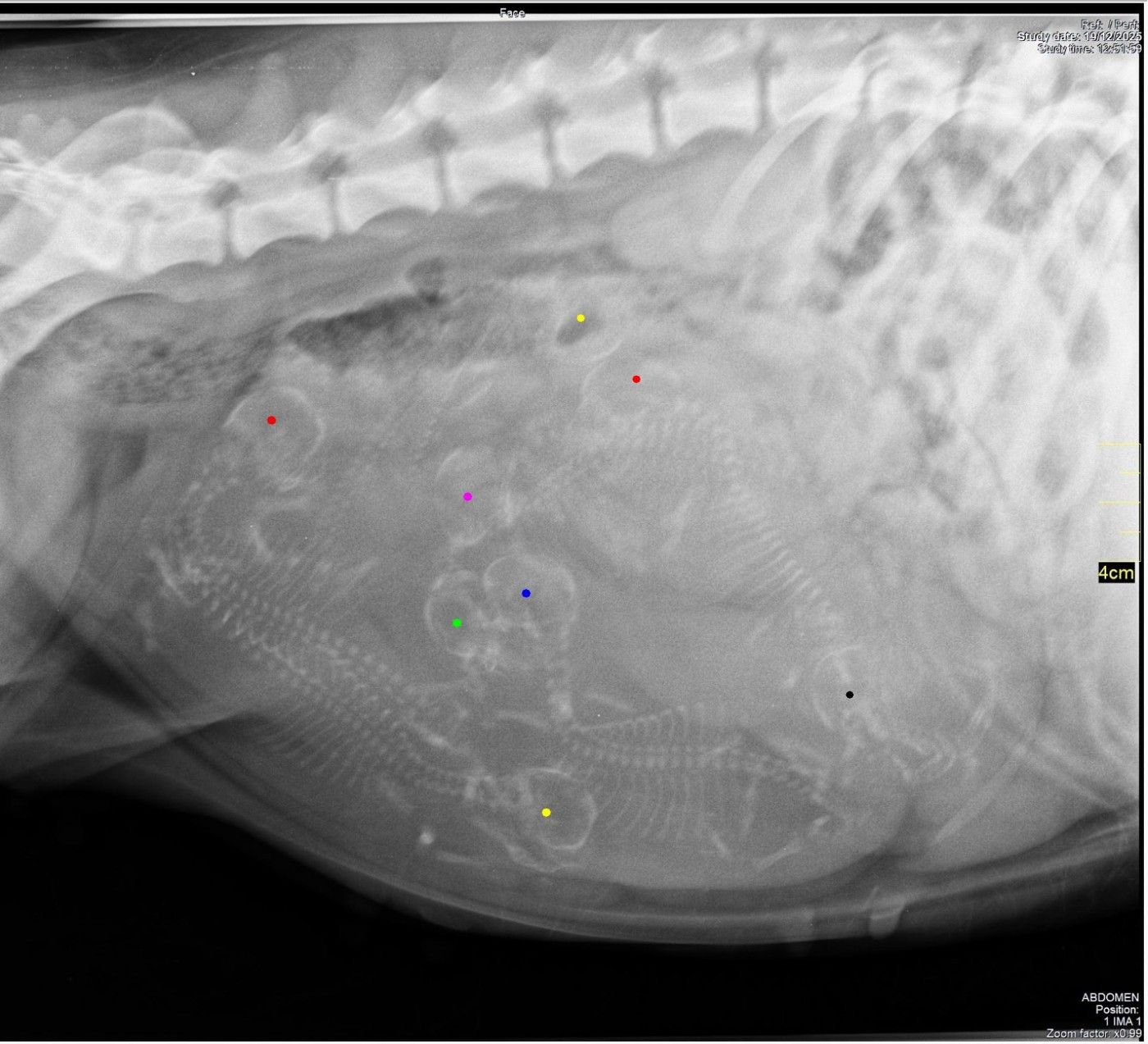 Radiographie de comptage